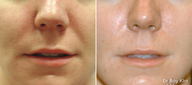 Juvederm