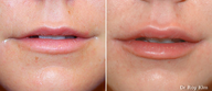 Juvederm