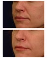 Juvederm