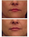 Juvederm