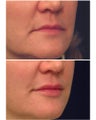 Juvederm