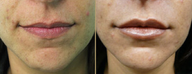 Hydrelle Injection For Treating Laugh Lines or Nasolabial Folds