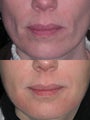 HA filler to the lower face