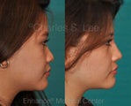 Nose