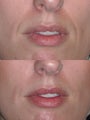 Filler to nasolabial folds