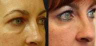 Juvederm Ultra