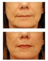 Perlane and Juvederm Injections for wrinkles and lip augmentation