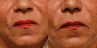Smile lines treated with Juvederm