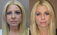 Juvederm