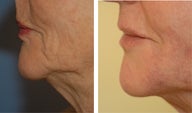 Juvederm