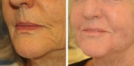 Juvederm
