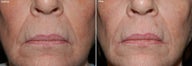 Juvederm