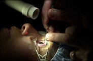 Lasik surgery