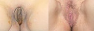 Labiaplasty before and after photos