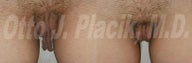 Labiaplasty
