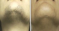  Laser Hair Removal for chin hairs