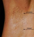 Laser hair removal of underarm 