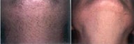 Laser Hair Removal
