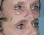 Fraxel repair with C02/Erbium lasers for upper lip wrinkles