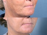 Laser Resurfacing for mouth wrinkles