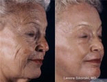 Full Face Erbium Laser