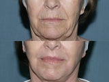Fraxel repair on full face and neck with Erbium and CO2 lasers for upper lip wrinkles