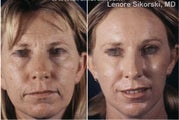 Laser Resurfacing