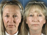 Eyelid Surgery