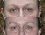 Laser resurfacing under the eyes