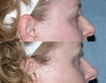 Laser resurfacing under the eyes