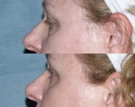 Laser resurfacing under the eyes