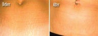Stretch marks treated with laser therapy