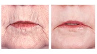 Laser skin resurfacing around the mouth
