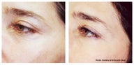 Laser skin resurfacing for crow's feet