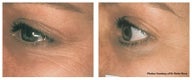 Laser skin resurfacing to crow's feet