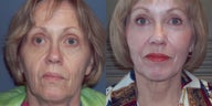 CO2 Laser skin resurfacing