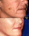 Laser Resurfacing
