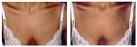 Laser skin resurfacing to remove freckles and hyperpigmenation