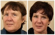 Full Face Laser Resurfacing