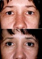 Blepharoplasty and Full Face CO2 Laser Resurfacing