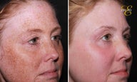 Laser Resurfacing