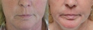 Full Face Laser