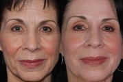 Laser Resurfacing