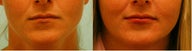 Silicone Lip Enhancement/Augmentation