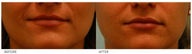 Silicone Lip Enhancement/Augmentation