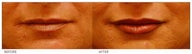 Silicone Lip Enhancement/Augmentation
