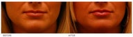 Silicone Lip Enhancement/Augmentation