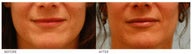 Silicone Lip Enhancement/Augmentation
