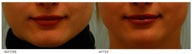 Silicone Lip Enhancement/Augmentation