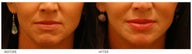 Silicone Lip Enhancement/Augmentation